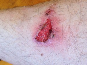 This is what happens when a scab on your shin sticks to your long-johns.  Also: Ouch.